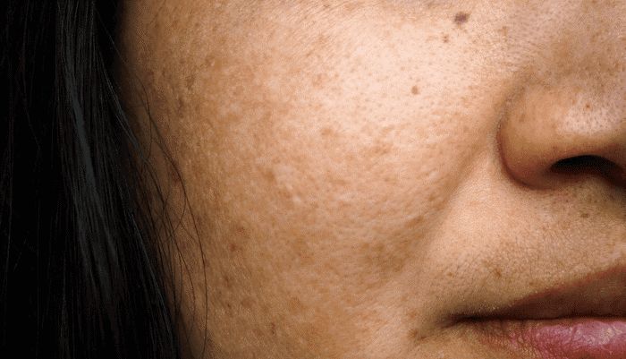 Phân biệt các tình trạng da sắc tố