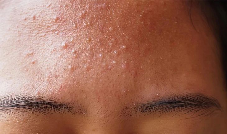 Cách chăm sóc da mụn ẩn an toàn, hiệu quả tại nhà