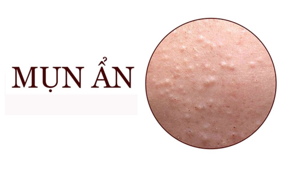 Mụn ẩn là gì? Nguyên nhân và cách chăm sóc da mụn ẩn an toàn tại nhà